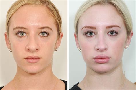 Rhinoplasty  The Most Common Of Nose Jobs
